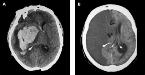 Patients With Intracerebral Hemorrhages The Ct Shows Multiple Acute 6d6