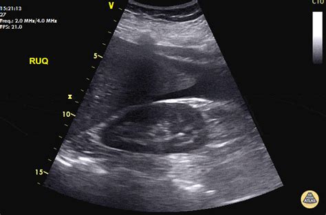 Ddxof Ultrasound In Ectopic Pregnancy — Tpa