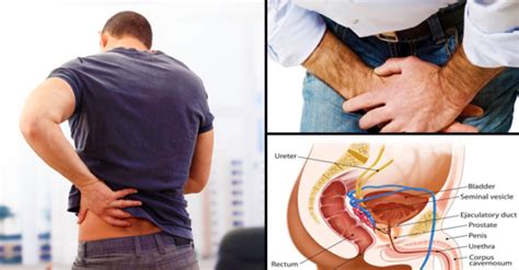 Symptoms of advanced prostate cancer include: 12 Early Warning Signs Of Prostate Cancer That Every Guy ...