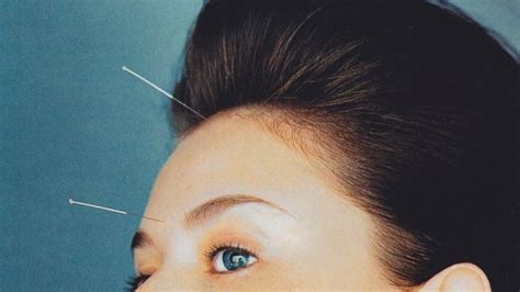 5 Surprising Beauty Benefits Of Acupuncture Dull Skin Acupuncture Beauty