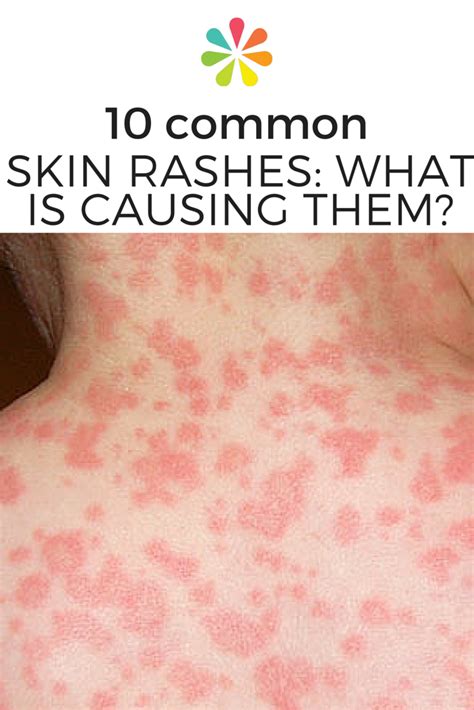 10 Most Common Types Of Skin Rashes Daily Health Valley Images And Photos Finder