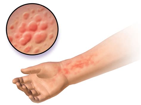 Difference Between Hives And Scabies Compare The Difference Between