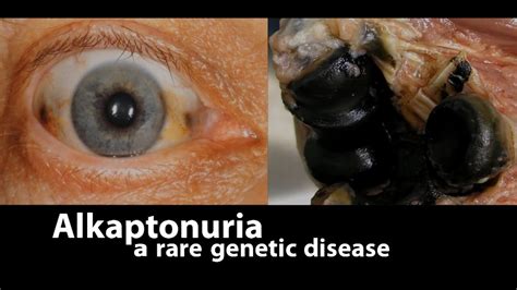 Alkaptonuria A Rare Genetic Disease Youtube