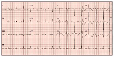 Ecg Diagnosis Deep T Wave Inversions Associated With Intracranial