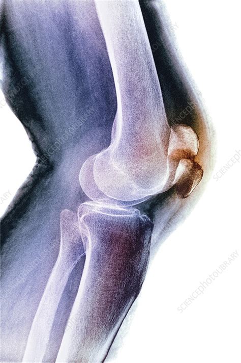 Fractured Kneecap X Ray Stock Image M3301568 Science Photo Library