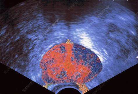 Prostate Ultrasound Stock Image C0349473 Science Photo Library