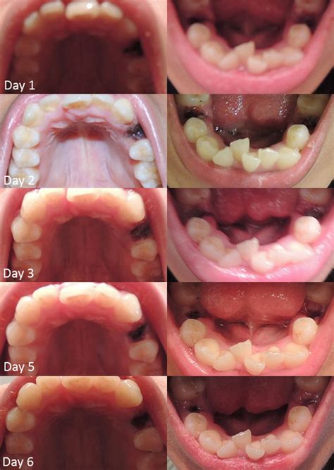 The reason for your molar extraction will determine which preventative method is the best choice. Braces: I'm a Work in Progress • Premolar Extraction Timeline