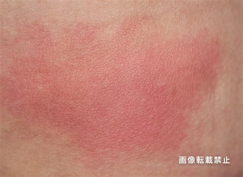 最も人気のある 肌 乾燥 ブツブツ - 新しいイメージ