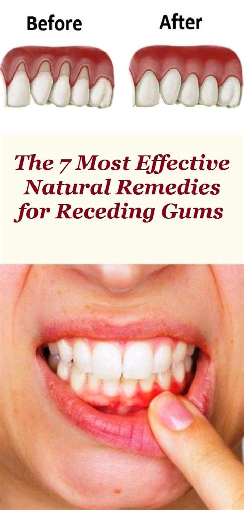 The 7 Most Effective Natural Remedies for Receding Gums | Receding gums