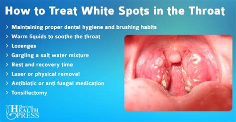 White Spots On Throat Common Causes Images Included Images And Photos Finder