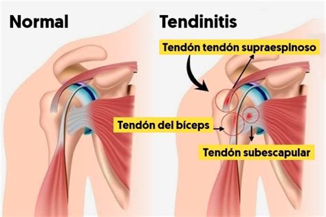 Tendinitis en el hombro Causas síntomas y tratamientos Blog Clínica Privada Jaime I