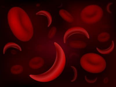 Die sichelzellenanämie ist eine erbliche erkrankung der roten blutkörperchen (erythrozyten). Sichelzellenanämie - Ursachen, Beschwerden & Therapie ...