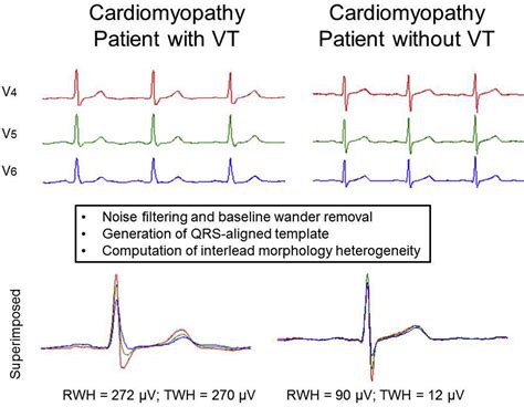 Tracking Interlead Heterogeneity Of R And T Wave Morphology To