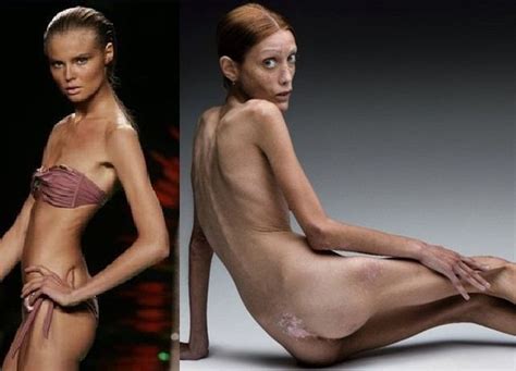 Isabelle Caro Pre Anorexia