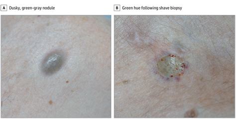 Asymptomatic Green Gray Nodules On The Chest Dermatology Jama
