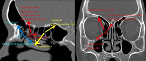 The Ethmoid Bone Clinical Imaging Anatomy From An Embryological Point Of View Semantic Scholar