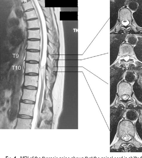 Figure 1 From Subarachnoid Subarachnoid Bypass For Spinal Adhesive