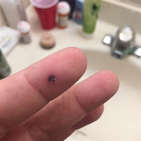Got A Blood Blister At Work To Pop Or Not To Pop Rpopping