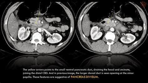 Ultimate Radiology Acute Pancreatitis With Hemorrhage And Pancreas My