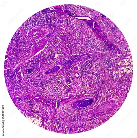 Skin Cancer Skin Biopsy Under Microscope Showing Basal Cell Carcinoma