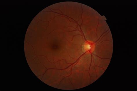 Optometry Retinal Imaging In Markham On Cornell Optometry