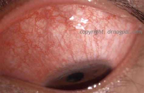 Conjunctivitis Dr Nagpals Centre For Cornea