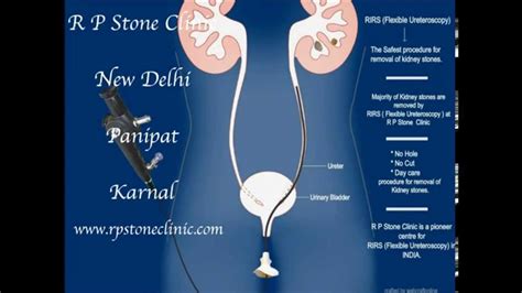 Animation Of Kidney Stone Treatment By Rirs Flexible Ureteroscopy