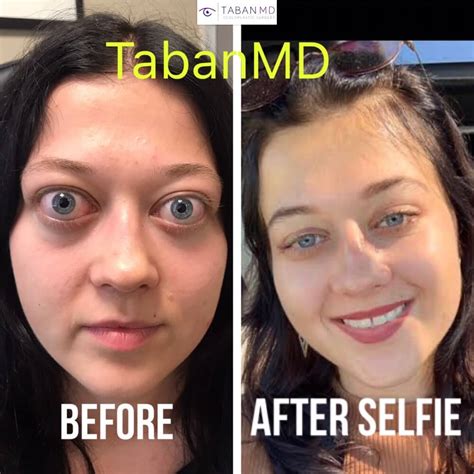 Graves Disease Before And After Gallery Taban Md