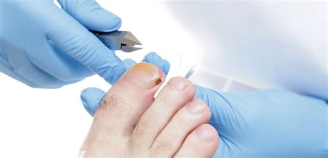 Ingrown Toe Nails Mobile Podiatrists Los Angles House Call Foot Doctor
