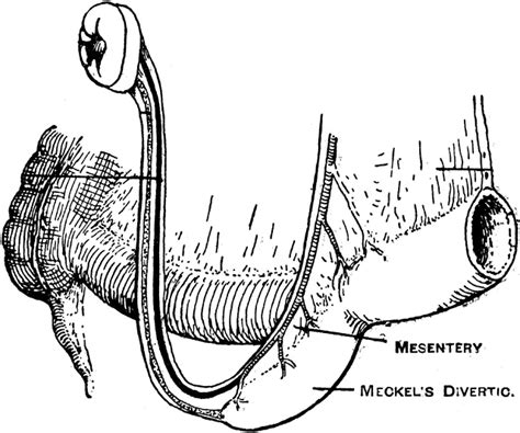 Meckels Diverticulum Clipart Etc