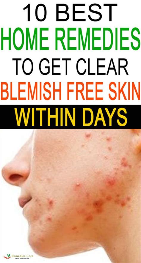 10 Best Home Remedies To Get Clear Blemish Free Skin Within Days