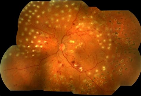 Diabetic Retinopathy With Laser Photocoagulation Retina Image Bank