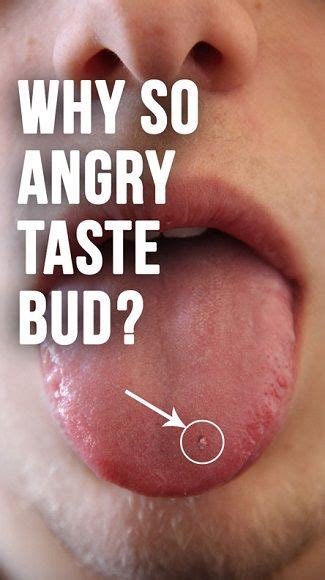 5 Natural Home Remedies To Relieve Swollen Taste Buds