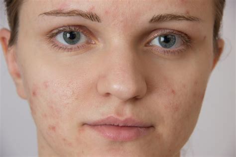 When To Consider Accutaneisotretinoin For Acne Skintour