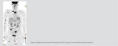 Figure 1 From A Case Of Fluorine 18 Fluorodeoxyglucose Positron