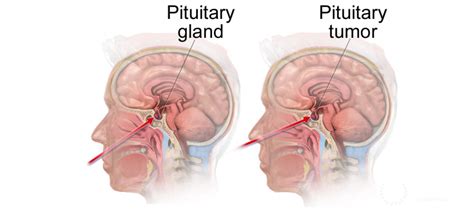 pituitary tumors