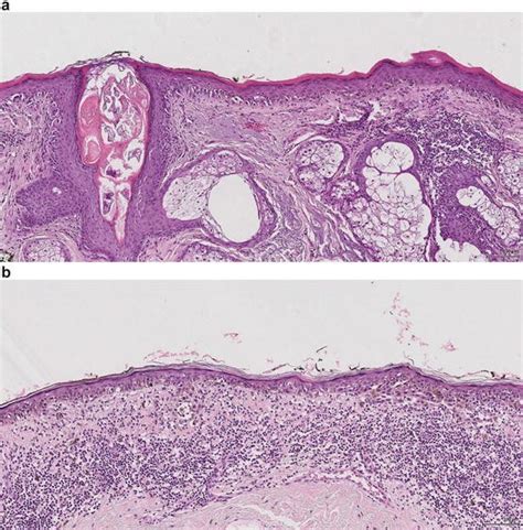 Melanoma In Situ Springerlink