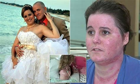 Florida Woman Speaks About Being Set On Fire By Husband Daily Mail Online