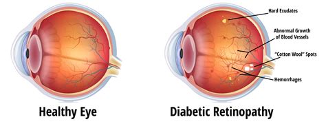 Diabetic Retinopathy Eyecare Associates Of South Tulsa