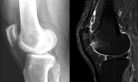 Validity Of Radiograph Based Infrapatellar Fat Pad Opacity Grading For