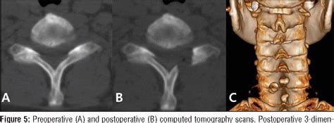 Figure From Posterior Percutaneous Endoscopic Cervical Foraminotomy And Diskectomy With