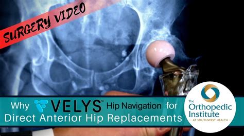 Velys Hip Navigation And Direct Anterior Hip Replacements Youtube