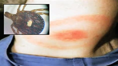 Tick Seen On Long Island Can Trigger Allergy To Red Meat Allergies