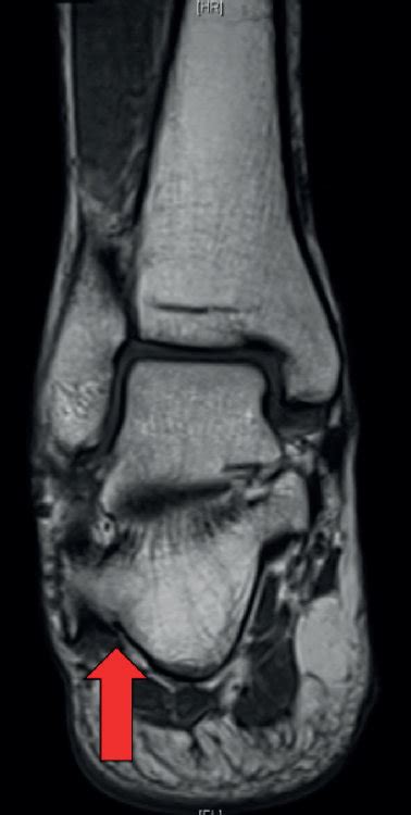 Right Foot Mri T1 Weighted Axial Image A Stir Axial Image B