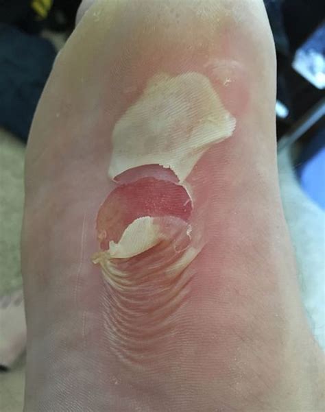 These Blisters Will Haunt Your Nightmares Runners World