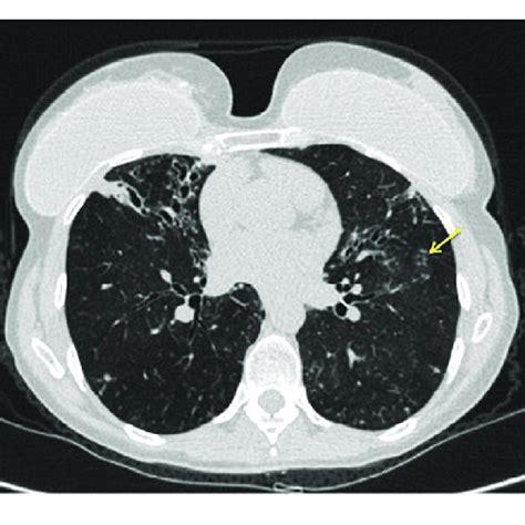 Left Ct Chest Showing Diffuse Ground Glass Centrilobular Nodules And