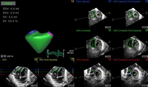 Rv Endocardial Surface Is Automatically Traced Over The Entire Cardiac