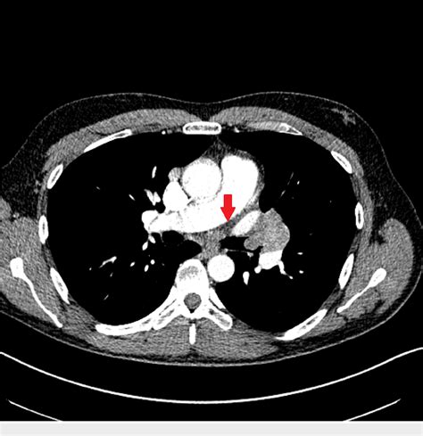 Figure 1 From Endobronchial Extranodal Marginal Zone B Cell Lymphoma