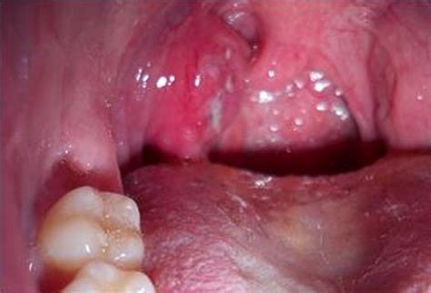 Strep Throat Pictures Symptoms Treatment Contagious Incubation Period