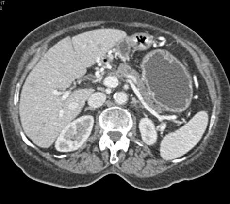 Carcinoma Tail Of Pancreas With Dilated Pancreatic Duct Pancreas Case